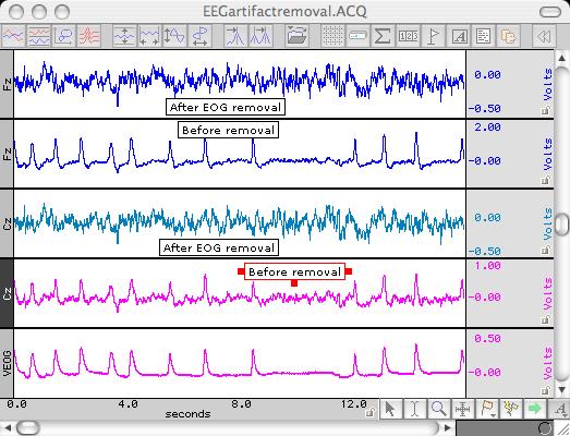 EEG Analysis Artifact Removal